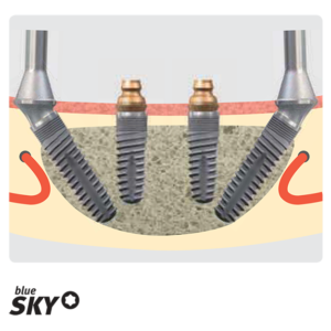 Bredent implant sistem BLUE SKY - Slika 6