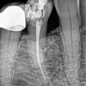 RVG Carestream CS 5200 size 1 - Slika 3