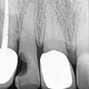 RVG Carestream CS 5200 size 1 - Slika 5