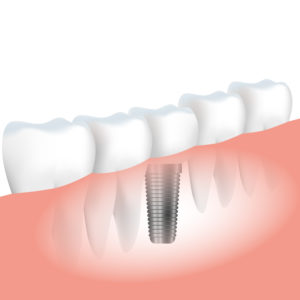 Bredent implant sistem BLUE SKY - Slika 4
