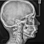 8_cs_9600_scan_ceph_lateral